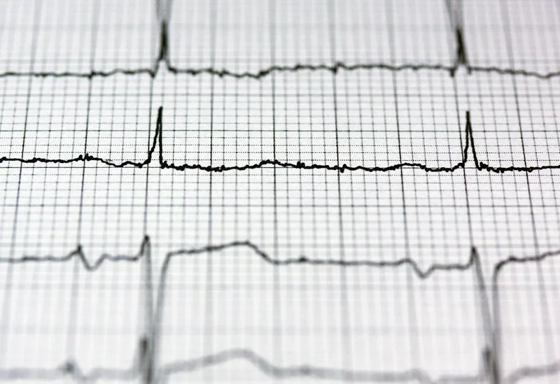 electrocardiograma en queretaro